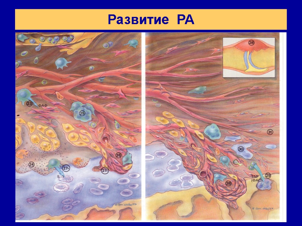 Развитие РА